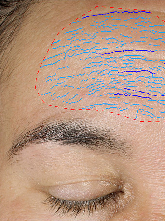 Persona B antes de usar el Set TimeWise Repair&reg; Avanzado en la zona de la frente.