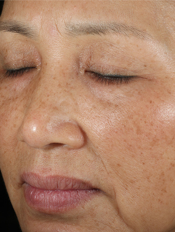 Persona C antes de usar el Set TimeWise Repair&reg; Avanzado en la zona de la mejilla.