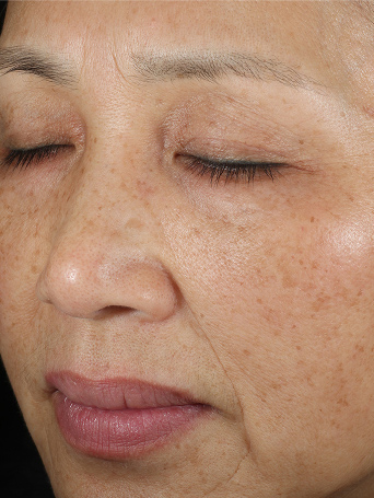 Persona C despu&eacute;s de usar el Set TimeWise Repair&reg; Avanzado en la zona de la mejilla, mostrando una piel m&aacute;s suave alrededor de la boca y los ojos.